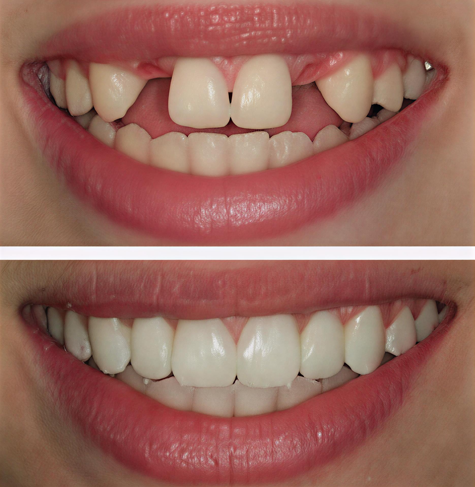 Partial denture